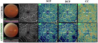 OCT angiography indices and the choroidal vascularity index in wild-type transthyretin (TTR) amyloidosis (ATTRwt)